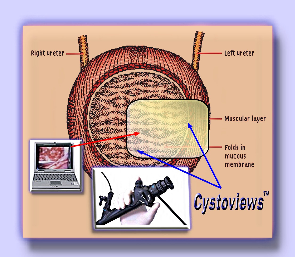 cystoill1rev2.jpg